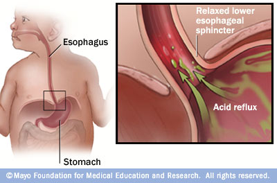 Infant Acid Reflux