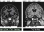 Alzheimer's disease