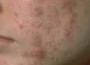 Acne Depression