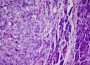 Cancer Detection