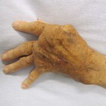 Hand with rheumatoid arthritis