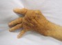 Hand with rheumatoid arthritis