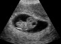 Miscarriage and Heart Attacks
