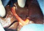 Liver Damage