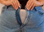 Gastric Bypass