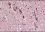 Parkinson's Disease