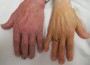 Anemia Symptoms