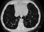 Emphysema