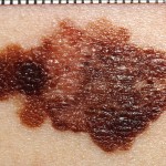 Melanoma Treatment