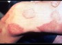 Leprosy