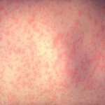 Measles Outbreak