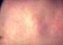 Measles Outbreak