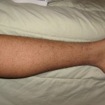 Restless Leg Syndrome