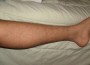 Restless Leg Syndrome