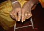 Rheumatoid Arthritis