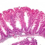 Colon Cancer