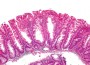 Colon Cancer