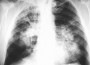 Tuberculosis Treatment