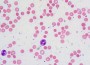 Anemia