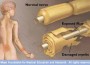 Guillain-Barre Syndrome