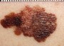 Skin Cancer