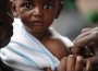 Whooping Cough