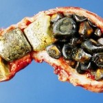 Researchers: Gallstones and Kidney Stones Closely Related 