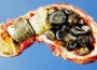 Researchers: Gallstones and Kidney Stones Closely Related