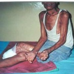 Leprosy Treatment Today and Tomorrow — New Study