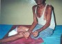 Leprosy Treatment Today and Tomorrow â€“ New Study