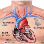 Recycled pacemakers from the U.S. to be donated to poor nations