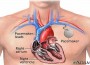 Recycled pacemakers from the U.S. to be donated to poor nations