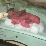 Study: Premature Babies 5 times more likely to develop Autism
