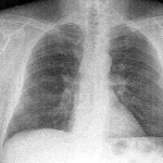 Chest X-Ray screening Ineffective against Lung Cancer 