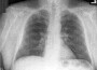 Chest X-Ray screening Ineffective against Lung Cancer