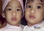 Conjoined twins successfully separated by Team of 40 Medical Staff