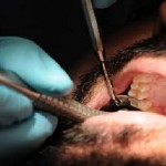 Dentist’s Revenge: Pulls Out Teeth of Ex-boyfriend After Break-up  