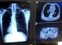Saudi Arabia Reports SARS-like Virus Victim